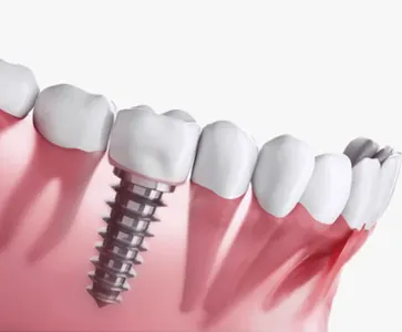 implante dentario